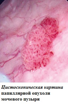 Цистоскопическая картина папиллярной опухоли мочевого пузыря