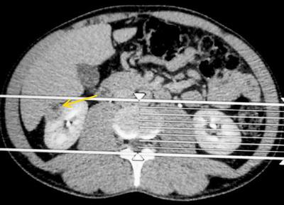 Рис.1 Мультиспиральная компьютерная томография <br />б)  аксиальный срез, паренхиматозная фаза. Стрелкой указана опухоль правой почки.