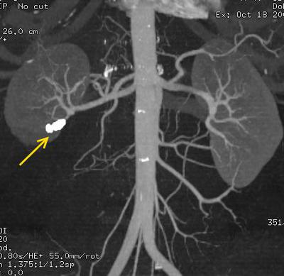 Рис.7 Мультиспиральная компьютерная томография.<br />МПР, сосудистая фаза. В месте отхождения ветви правой нижнесегментарной почечной артерии визуализируются металлические спирали (стрелка).
