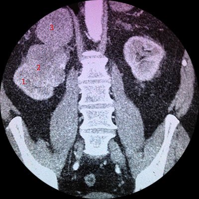 Мультиспиральная компьютерная томограмма. 1 — Нормальная ткань правой почки, 2 — Опухоль правой почки, 3 — Опухоль правого надпочечника.