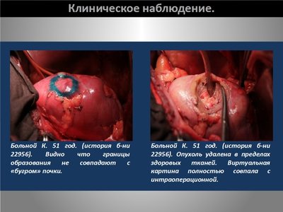 Определение интраренальных границ опухоли при выполнении органосохраняющих операций на почке — слайд 21