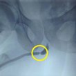 Анастомотическая уретропластика при стриктуре уретры