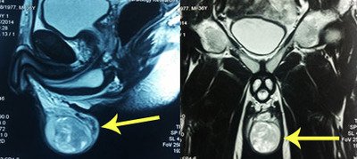 Изображение: МРТ. Опухоль левого яичка.