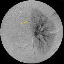 Рис.7 Селективная почечная артериограмма слева. В верхнем сегменте  почки по задней медиальной поверхности определяется гиперваскулярная опухоль (стрелка).
