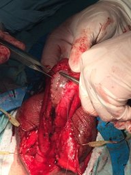 Фиксация трансплантата из слизистой полости рта в зону стриктуры пенильной уретры.