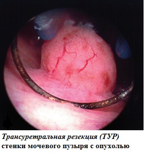 Трансуретральная резекция (ТУР) стенки мочевого пузыря с опухолью