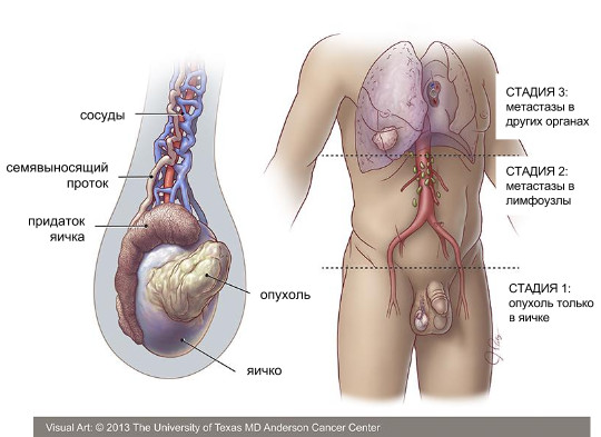 Рак яичка: схема и стадии