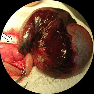 Рис.1: Некротически измененные яичко и придаток, с кровоизлияниями. Стрелкой указано место перекрута, выше которого семенной канатик без патологических изменений.