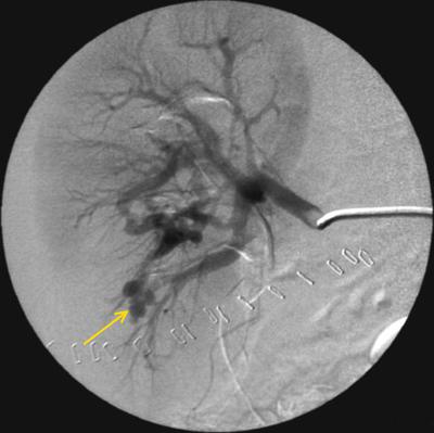 Рис.2 Селективная почечная аретриография справа.<br />Катетер Cobra 5Ф в правой почечной артерии. Определяется аретриовенозное соустье в бассейне нижнесегментарной артерии (стрелка).