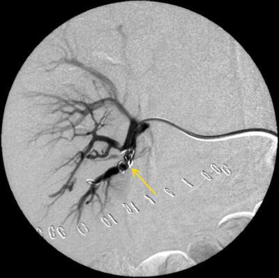 Рис.4 Селективная почечная артериография слева.<br />В нижнесегментарную артерию имплантированы спирали IMWCE-38-8-5.