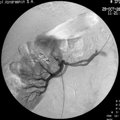 Рис.11 Селективная почечная артериография справа.<br />Определяются субсегментарные артериальные ветви, питающие опухоль (стрелка).
