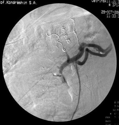 Рис.12 Селективная почечная артериография справа.<br />Эмболизация нижней и верхней субсегментарной артериальной ветви спиралью MWCE-18S-6,0-5-HILAL.