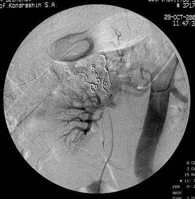 Рис.13 Селективная почечная артериография справа.<br />Эмболизация задней субсегментарной артериальной ветви, питающей опухоль спиралью MWCE-18S-6,0-5-HILAL.