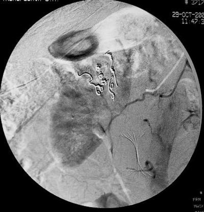Рис.14 Селективная почечная артериография справа – контроль.<br />Отмечается полная окклюзия питающих артерий. Коллатеральный кровоток к опухоли отсутствует.