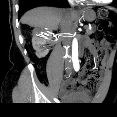 Рис.17 Мультиспиральная компьютерная томография.<br />МПР, сосудистая фаза. Опухоль правой почки (стрелка). Накопление контрастного вещества опухолью отсутствует.
