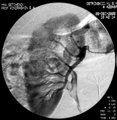 Рис.3 Селективная почечная артериография справа.<br /> Стрелками указана зона опухоли и кавафильтр.