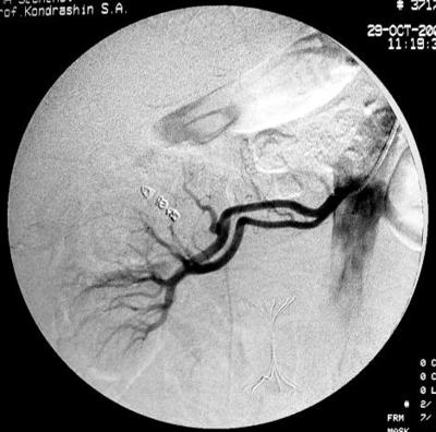 Рис.4 Селективная почечная артериография справа.<br />В верхнесегментарную артерию, питающую опухоль имплантированы спирали IMWCE-38-8-5.