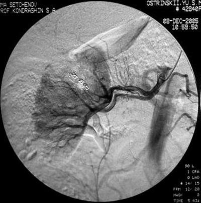 Рис.7 Селективная почечная артериография справа.<br />В верхнесегментарную артерию, питающую опухоль имплантированы спирали IMWCE-38-8-5.
