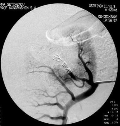 Рис.8 Селективная почечная артериография справа.<br />Отмечается полная окклюзия артерии, питающей опухоль.