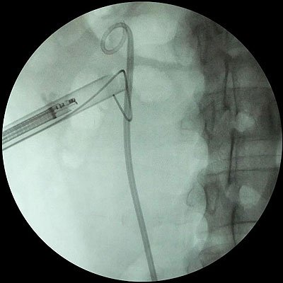 Рис.9: Этап операции. Удаление резидуальных камней с помощью гибкого эндоскопа.