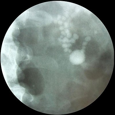 Рис.1: Обзорный рентгенологический снимок. Множественные тени, подозрительные на конкремент в проекции левой 		почки.