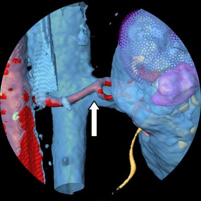Компьютерное 3D моделирование патологического процесса. Опухоль правой почки. Вид сзади. Стрелкой указано деление правой почечной артерии на сегментарные.