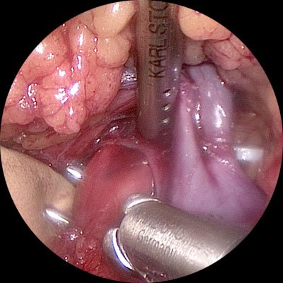 Во время операции. Выделена правая почечная артерия, расположенная под почечной веной.