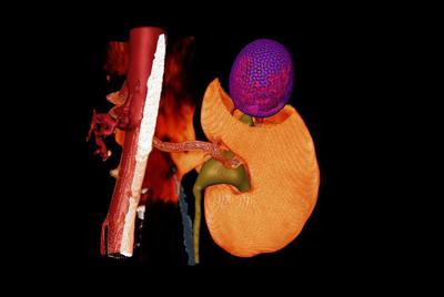 Опухоль правой почки (вид сзади). Виртуальная резекция почки. В зону резекции попадает сегментарная почечная артерия и верхняя чашечка.