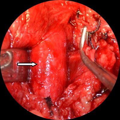 Рис.3: Интраоперационно: левая почечная вена (на зажиме) впадает в нижнюю полую вену позади аорты (указана стрелкой).