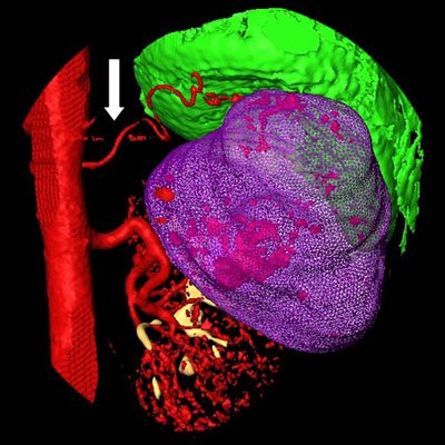 Компьютерное 3D моделирование патологического процесса. Опухоль правой почки. Вид сзади. Опухоль (фиолетовая) интимно прилежит к нижней поверхности печени (зеленая). Стрелкой указана дополнительная почечная артерия.