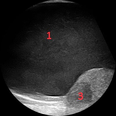 1 – жидкость вокруг правого яичка (гидроцеле). 2 – правое яичко. 3 – опухоль правого яичка.