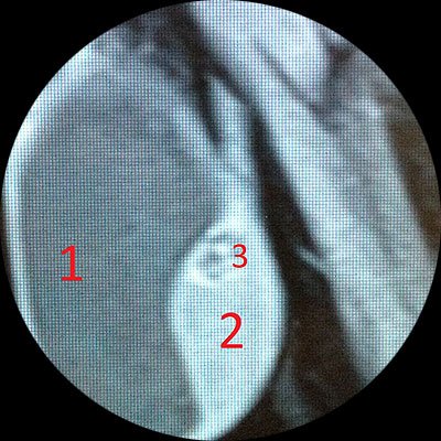 1 – жидкость вокруг правого яичка (гидроцеле). 2 – правое яичко. 3 – опухоль правого яичка.