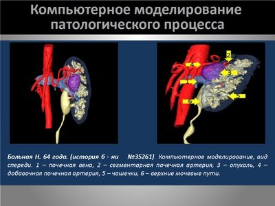 Определение интраренальных границ опухоли при выполнении органосохраняющих операций на почке — слайд 8
