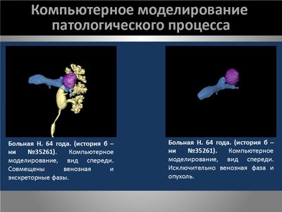 Определение интраренальных границ опухоли при выполнении органосохраняющих операций на почке — слайд 9