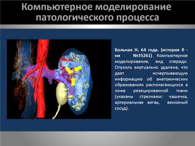 Определение интраренальных границ опухоли при выполнении органосохраняющих операций на почке — слайд 10