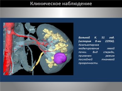 Определение интраренальных границ опухоли при выполнении органосохраняющих операций на почке — слайд 14