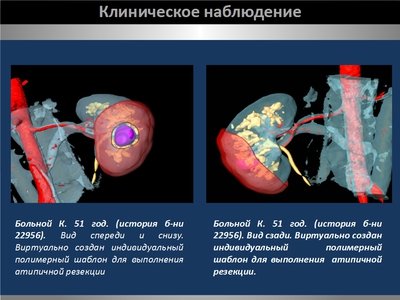 Определение интраренальных границ опухоли при выполнении органосохраняющих операций на почке — слайд 17