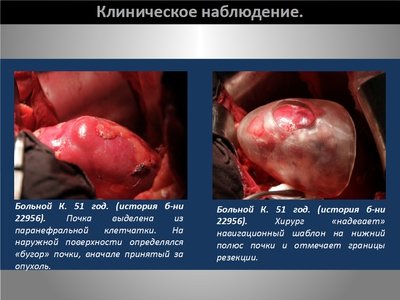 Определение интраренальных границ опухоли при выполнении органосохраняющих операций на почке — слайд 20