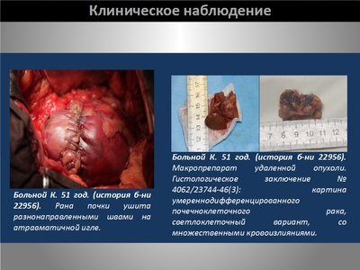 Определение интраренальных границ опухоли при выполнении органосохраняющих операций на почке — слайд 22