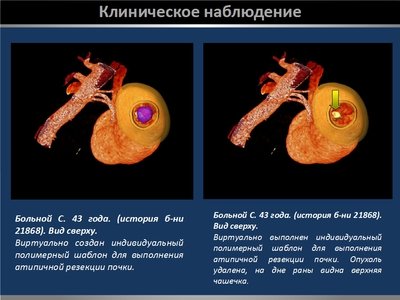 Определение интраренальных границ опухоли при выполнении органосохраняющих операций на почке — слайд 25