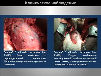 Определение интраренальных границ опухоли при выполнении органосохраняющих операций на почке — слайд 27