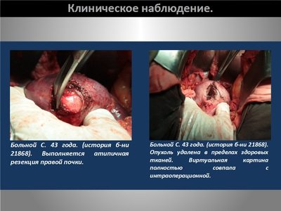 Определение интраренальных границ опухоли при выполнении органосохраняющих операций на почке — слайд 28