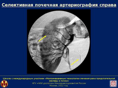Селективная почечная артериография справа