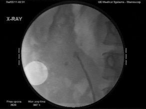 Обзорная рентгеноскопия мочевых путей  (больная на животе)