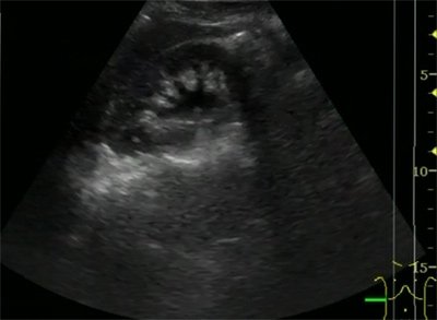 УЗИ. Гидронефроз справа, состояние после дренирования верхних мочевых путей.