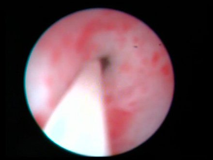 Рис 3. Уретероскопия слева – сужение нижней трети левого мочеточника.