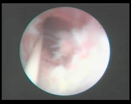Рис. 4. Лазерная уретеротомия нижней трети левого мочеточника.