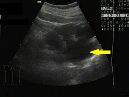 Ультрасонограмма правой почки.  Определяется уретерогидронефроз справа (указано стрелкой).