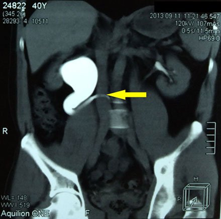 Компьютерная томограмма органов брюшной полости. Уретерогидронефроз справа. Ретрокавальное расположение правого мочеточника (указано стрелкой).