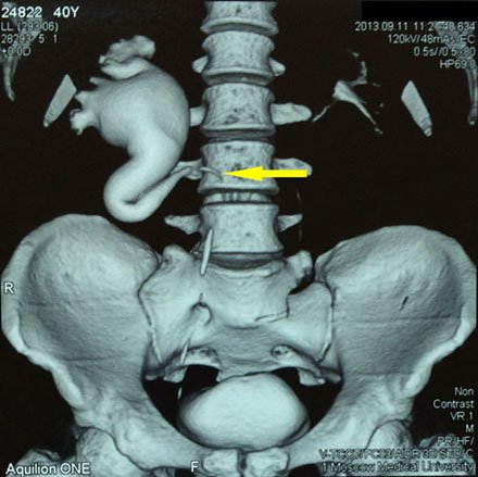 Компьютерная томограмма органов брюшной полости. Уретерогидронефроз справа. Ретрокавальное расположение правого мочеточника (указано стрелкой).